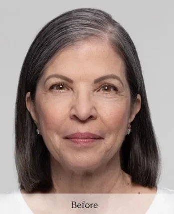 SKINVIVE — full face, before and after