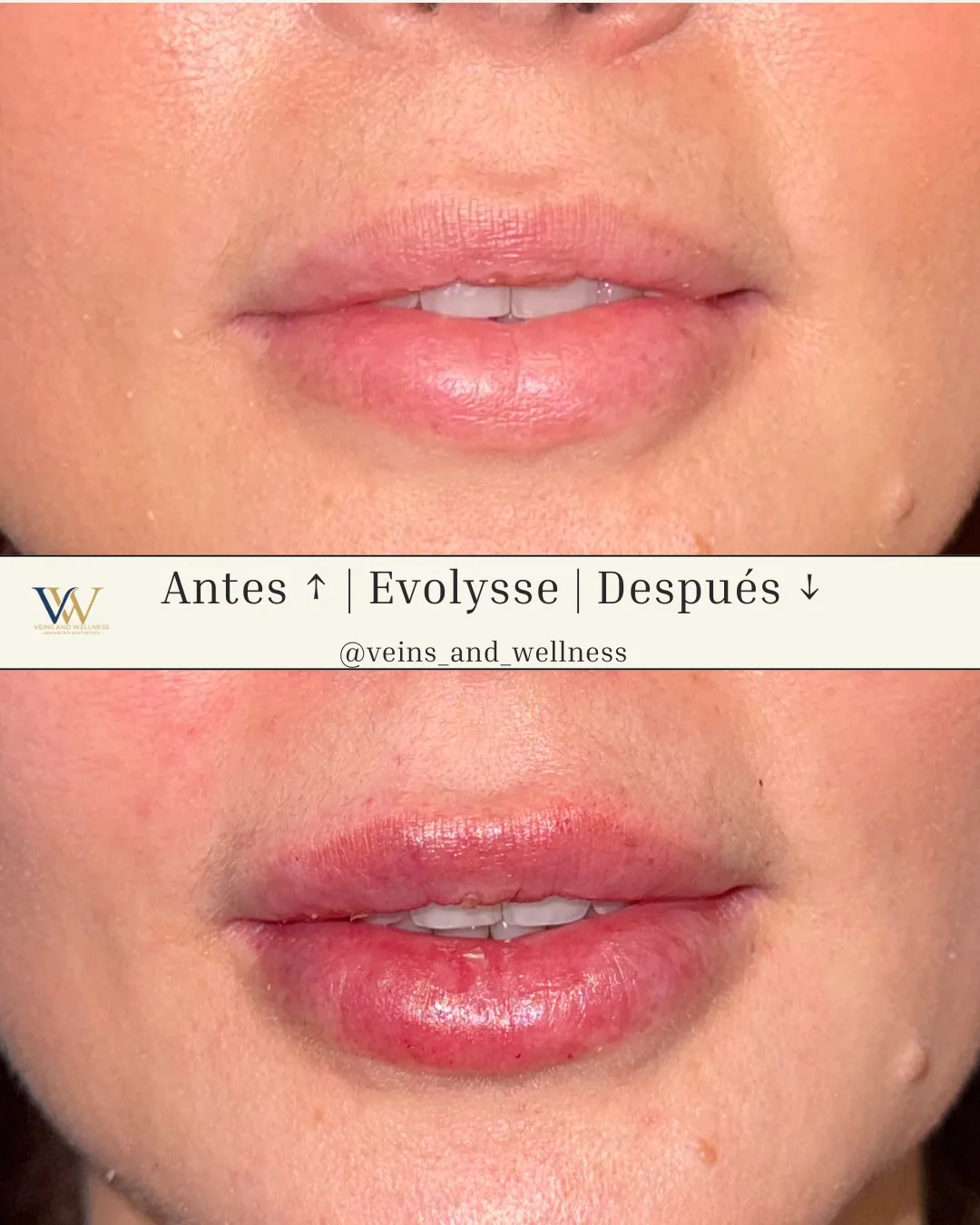 Evolysse lip filler — before and after
