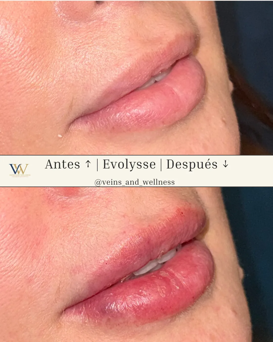 Evolysse lip filler — profile, before and after