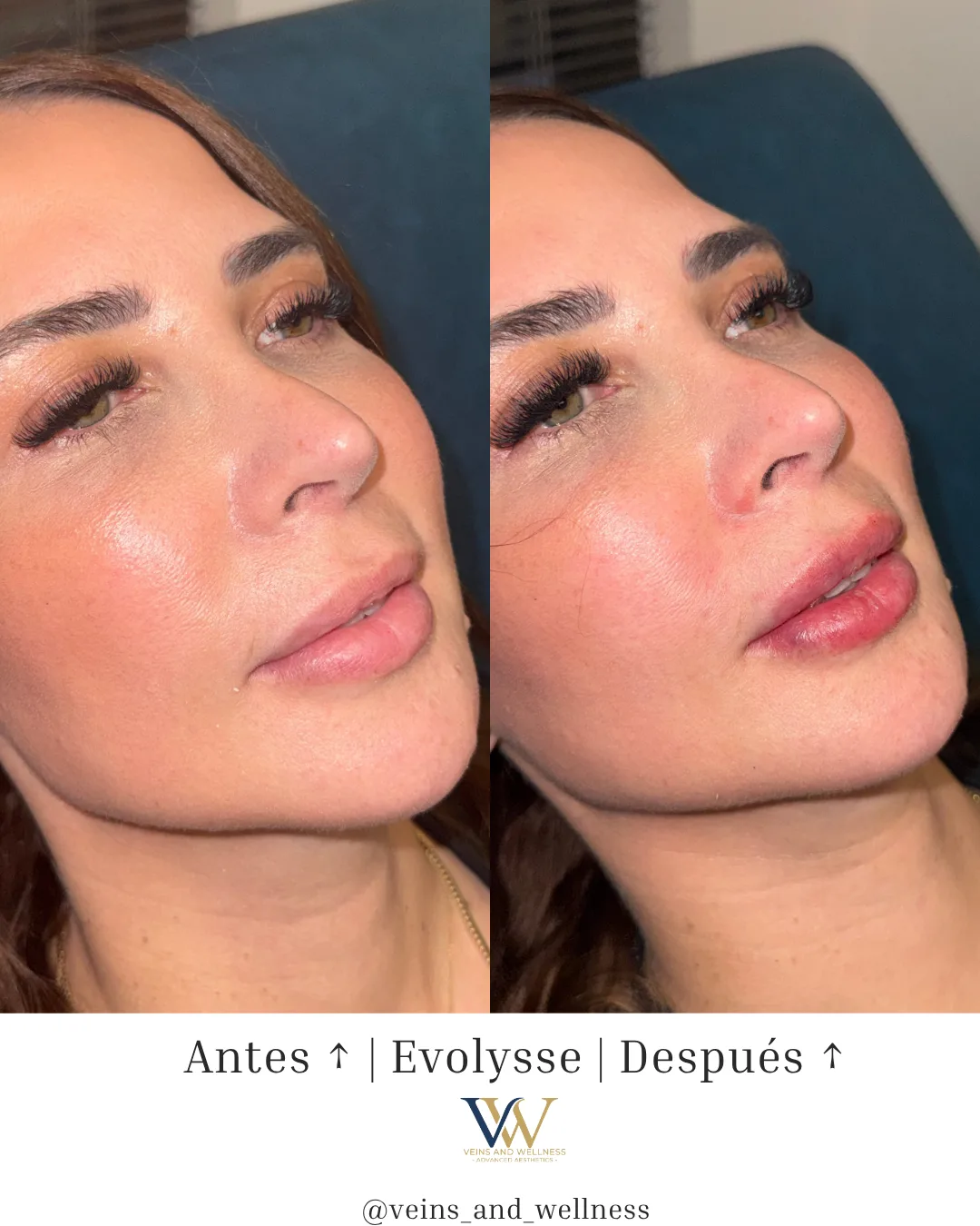 Evolysse lip filler — three-quarter view, before and after