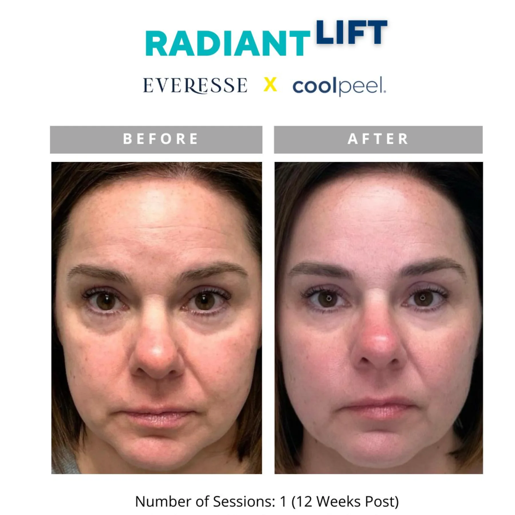 Radiant Lift before and after — 1 session, 12 weeks post