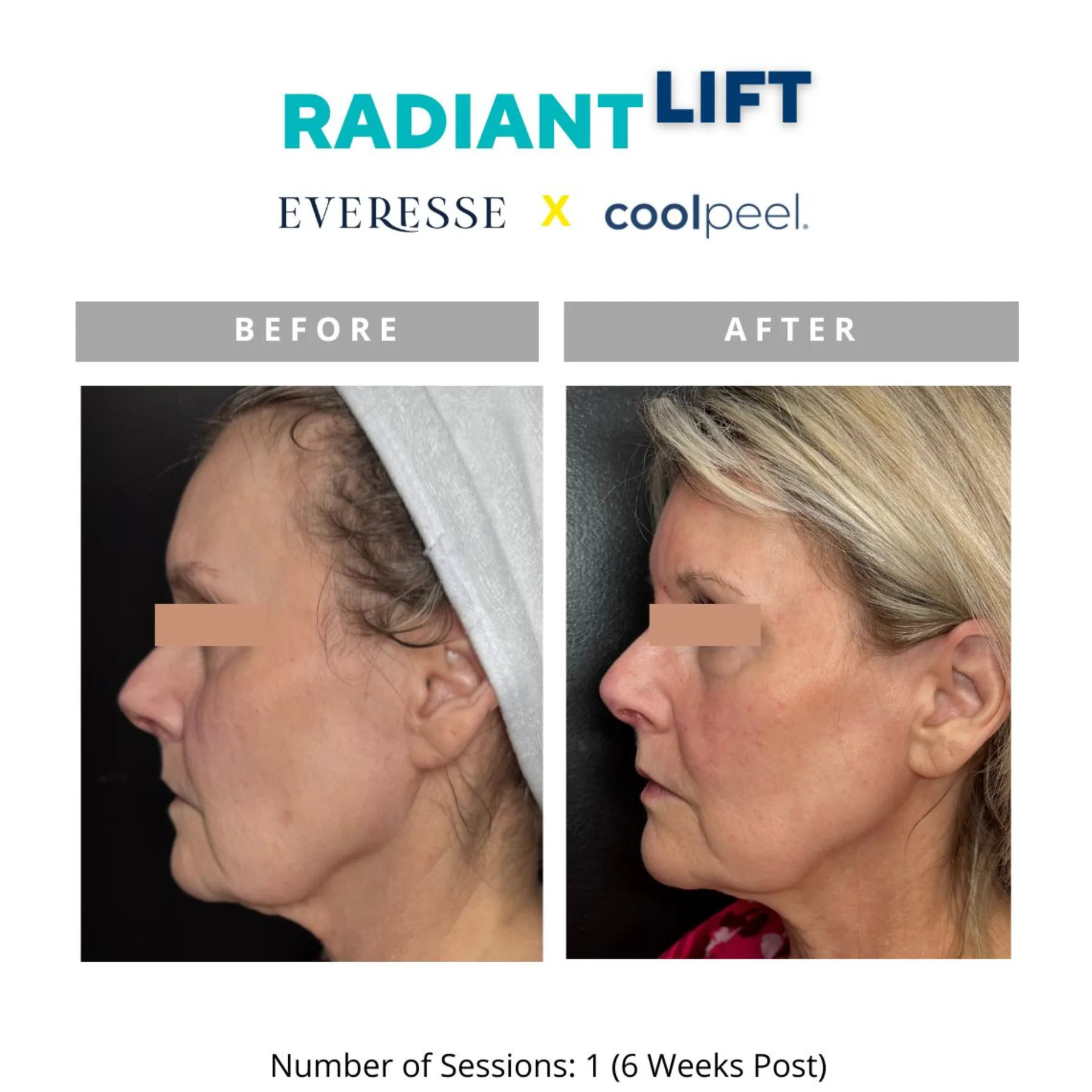 Radiant Lift before and after — 1 session, 6 weeks post