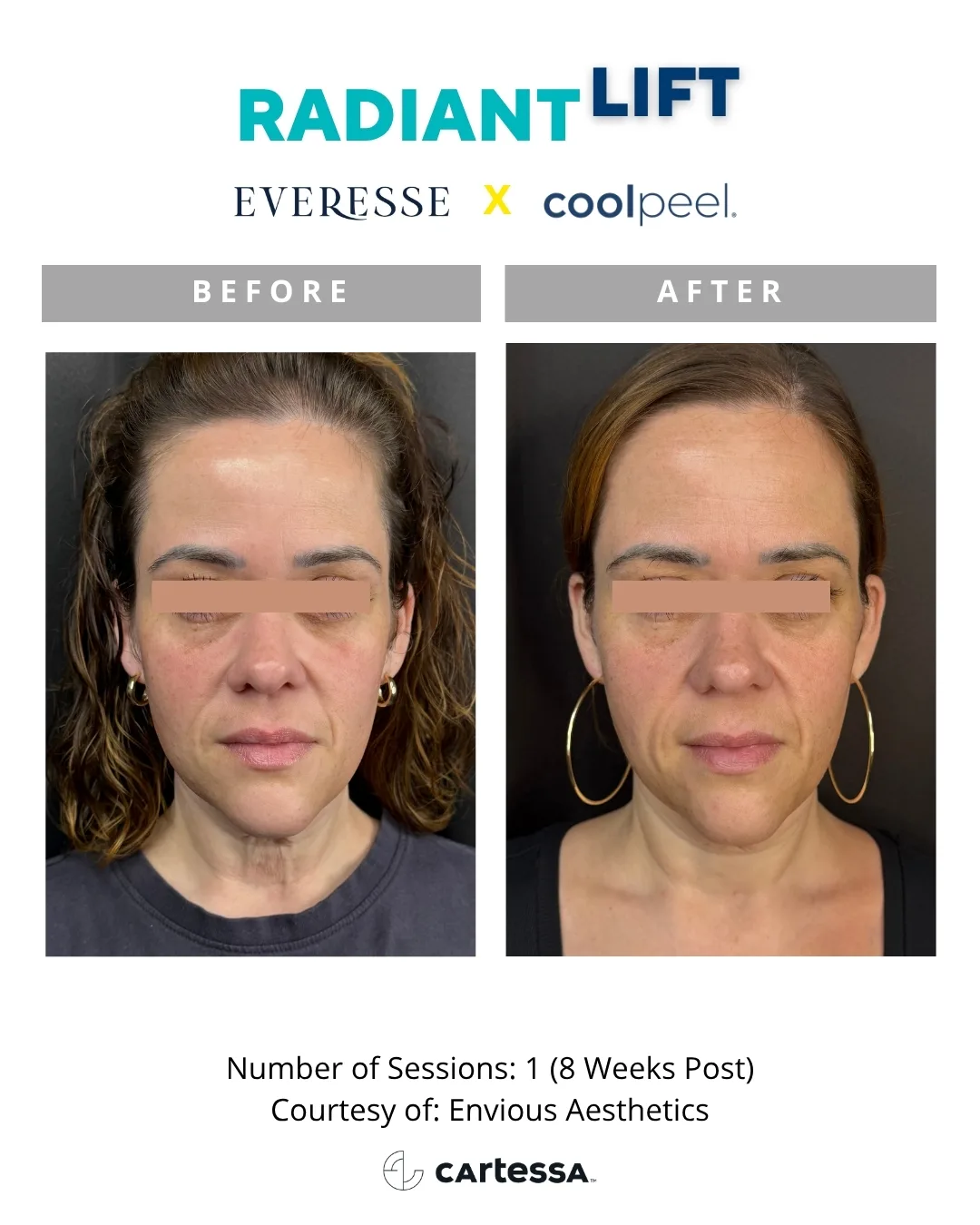 Radiant Lift before and after — 1 session, 8 weeks post (courtesy Envious Aesthetics)