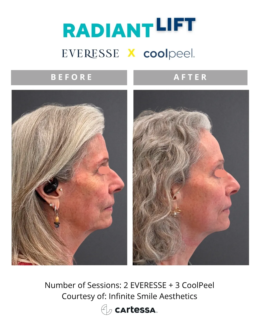 Radiant Lift before and after — 2 Everesse + 3 CoolPeel, profile (courtesy Infinite Smile Aesthetics)