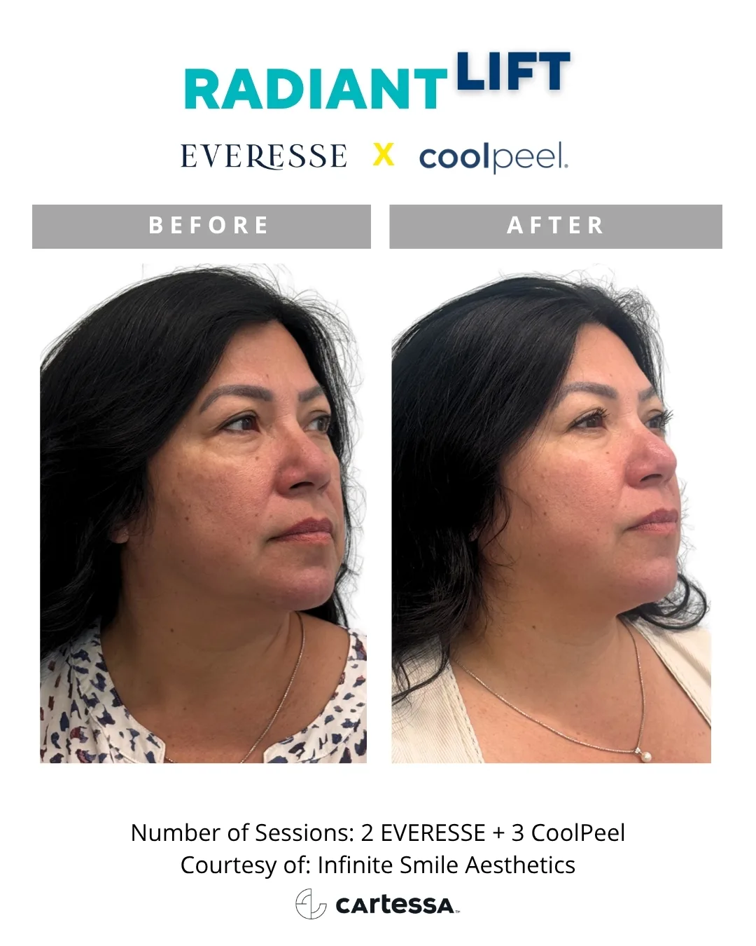 Radiant Lift before and after — 2 Everesse + 3 CoolPeel, three-quarter view (courtesy Infinite Smile Aesthetics)