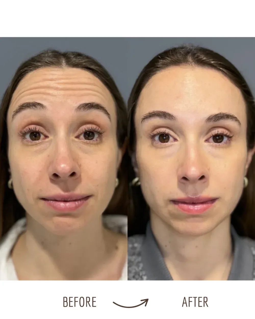 Wrinkle relaxers — forehead lines, before and after
