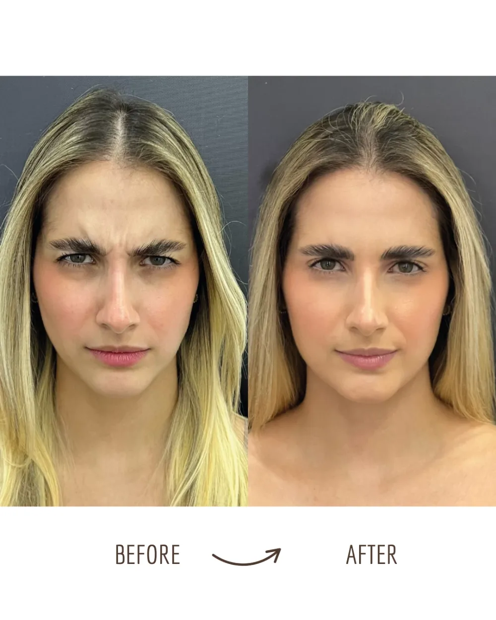 Wrinkle relaxers — frown lines (11s), before and after