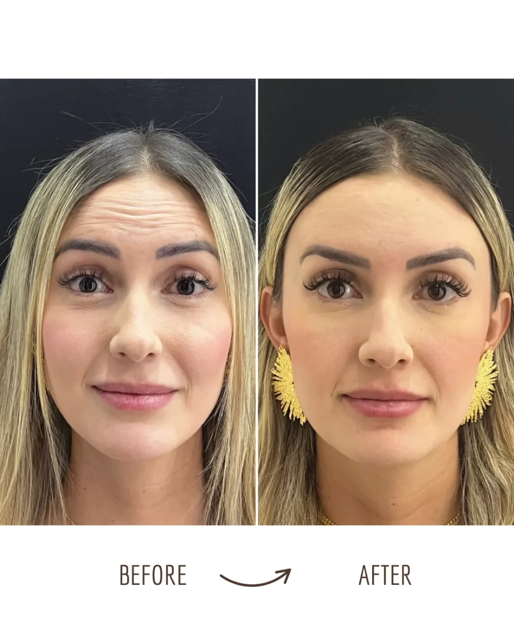 Wrinkle relaxers — forehead, before and after