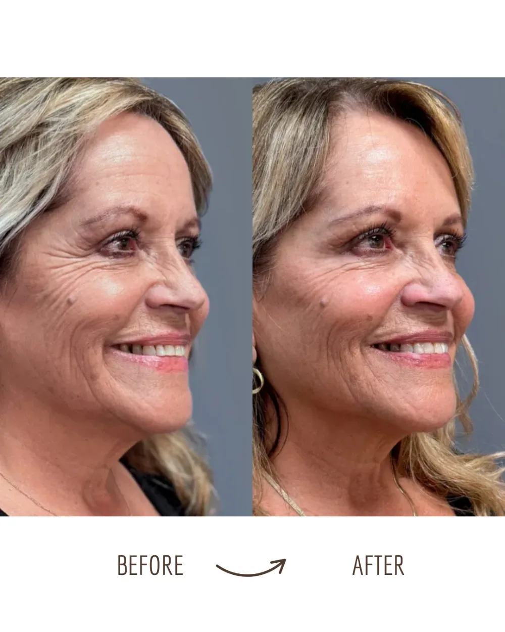 Wrinkle relaxers — profile, softened lines