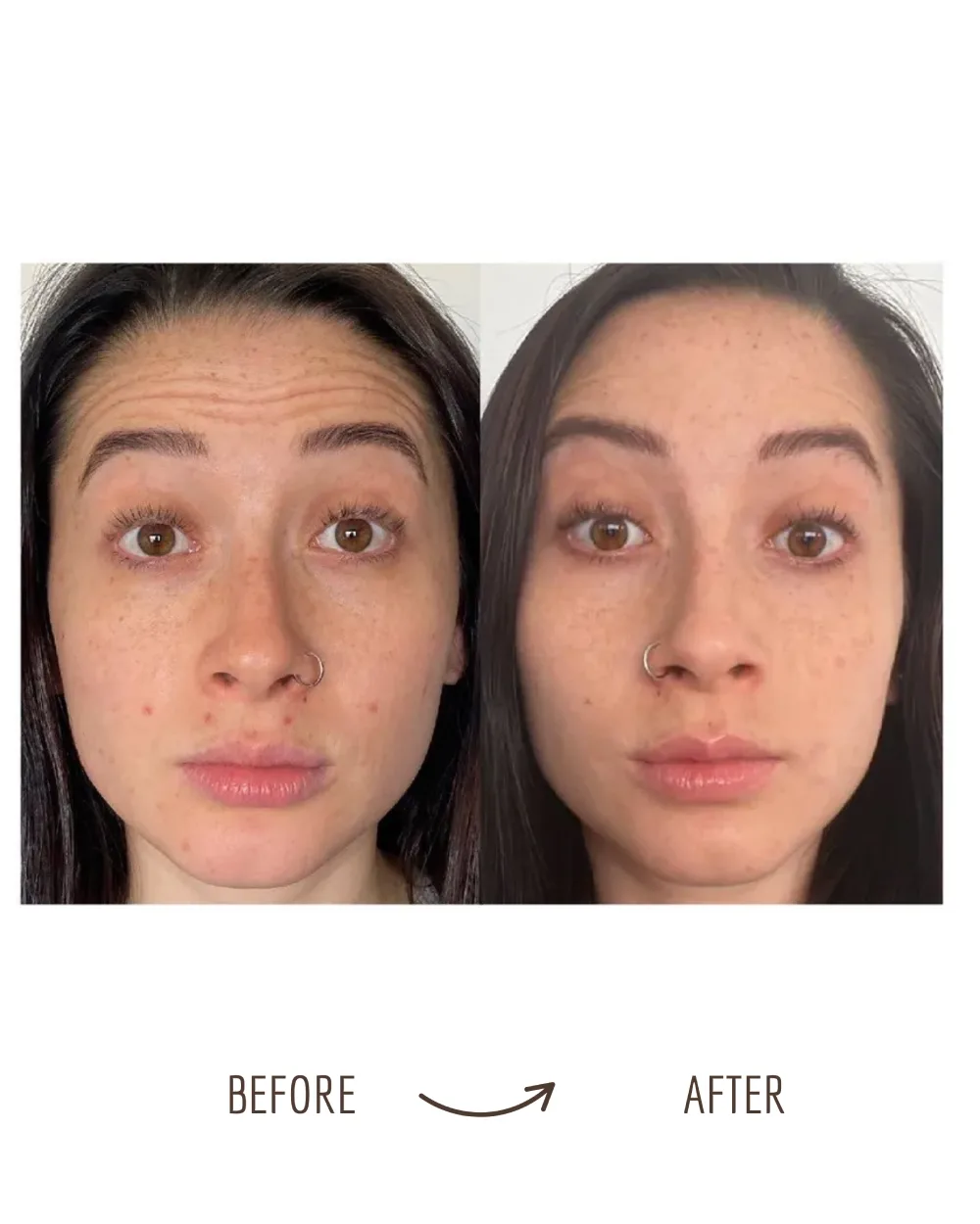 Wrinkle relaxers — forehead and skin, before and after