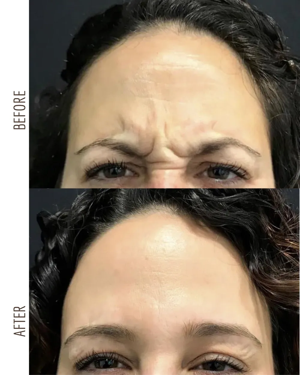 Wrinkle relaxers — glabella close-up, before and after
