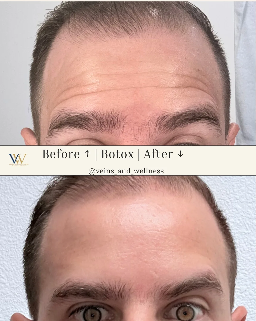 Botox — forehead lines, before and after