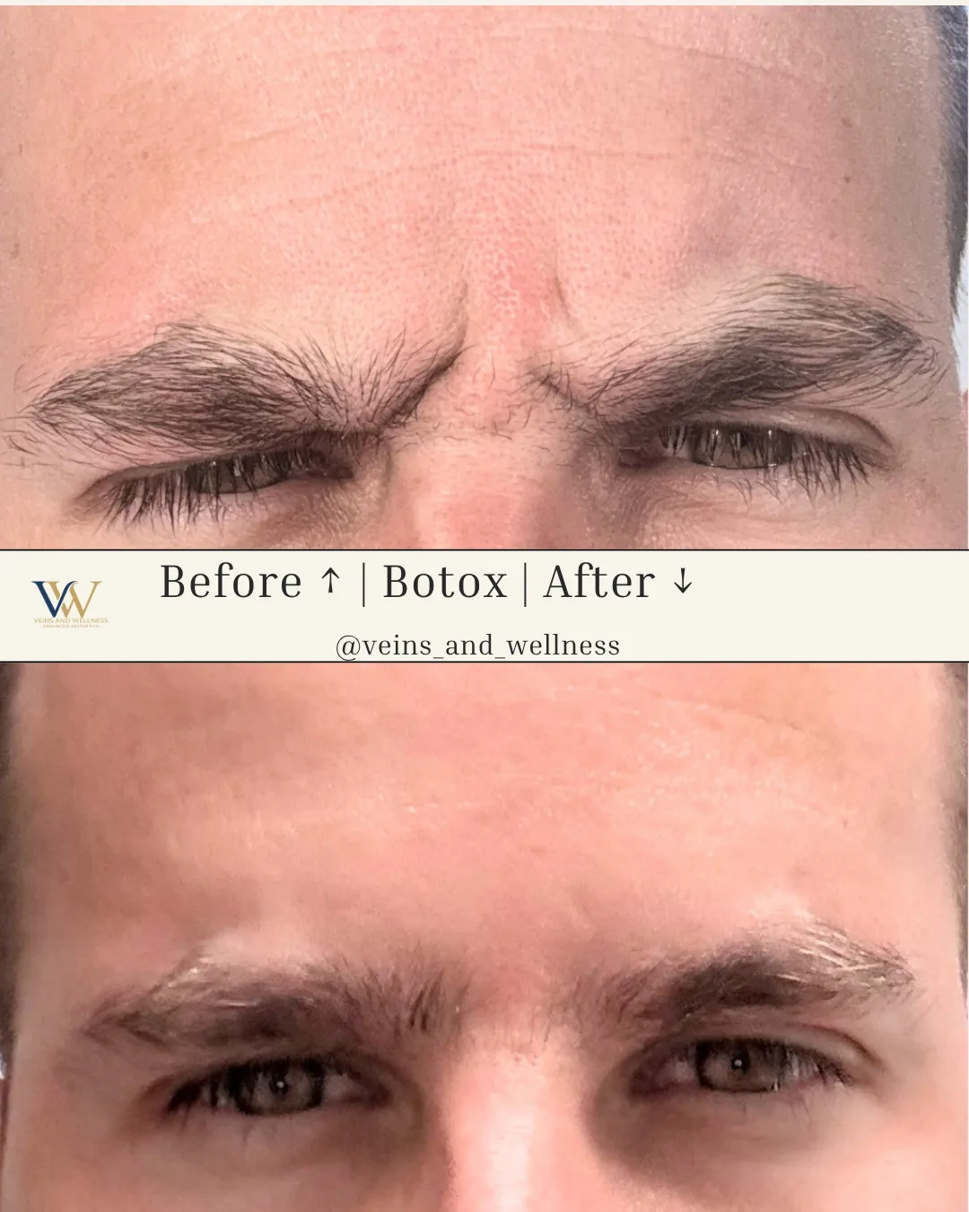 Botox — glabella / frown lines, before and after