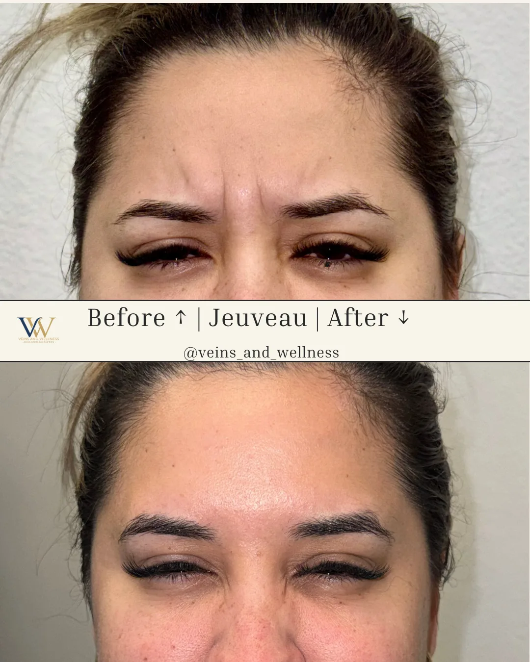 Jeuveau — frown lines, before and after