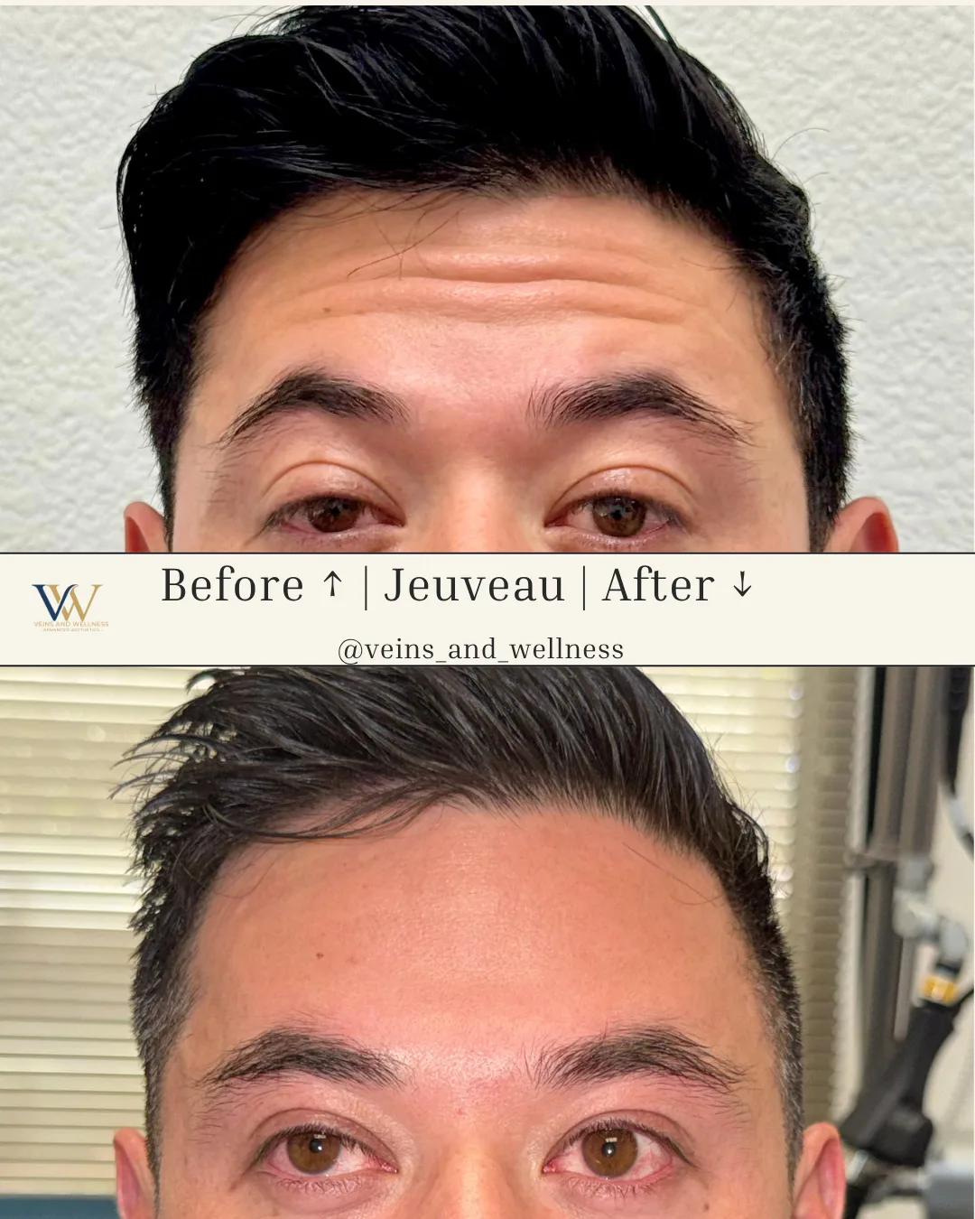 Jeuveau — forehead lines, before and after