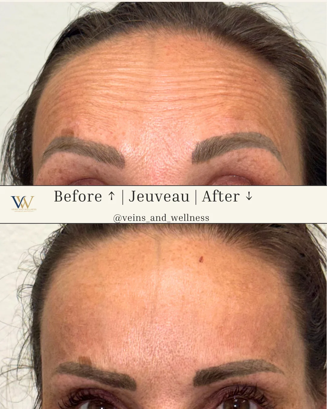 Jeuveau — forehead lines, before and after
