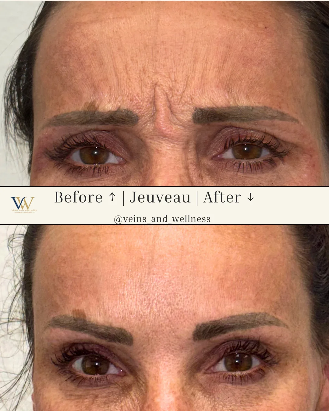 Jeuveau — glabella, before and after