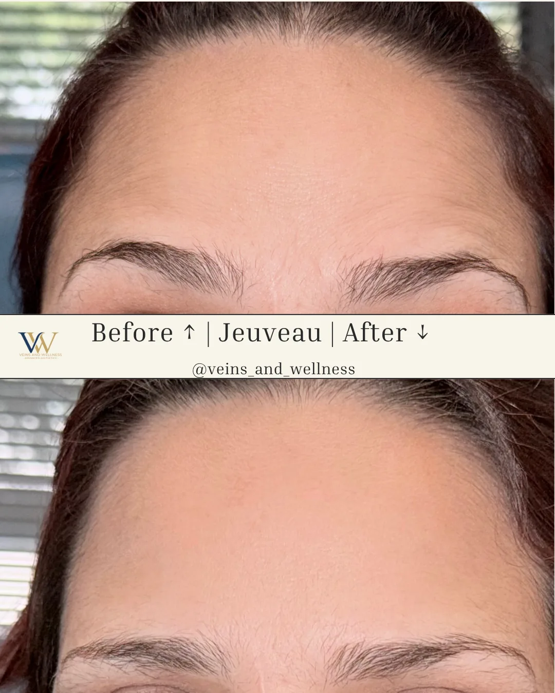 Jeuveau — forehead, before and after