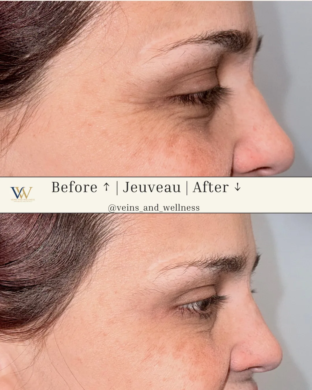 Jeuveau — crow’s feet, profile, before and after