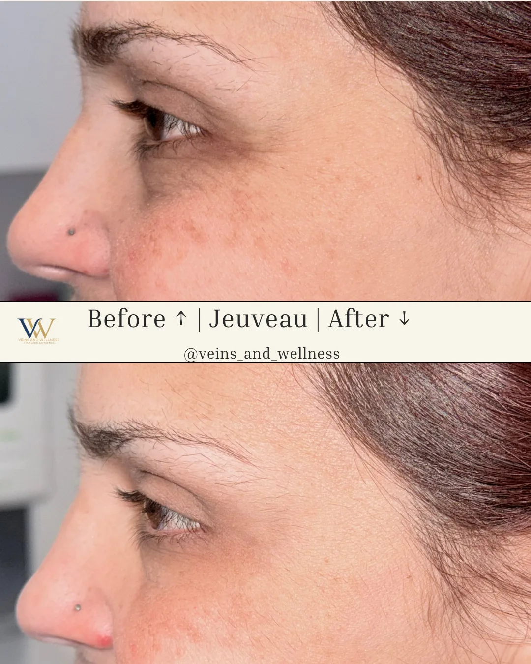 Jeuveau — crow’s feet and cheeks, profile, before and after