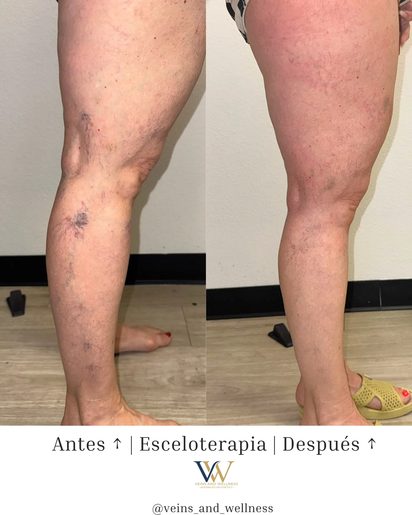 Sclerotherapy before and after at Veins and Wellness Las Vegas