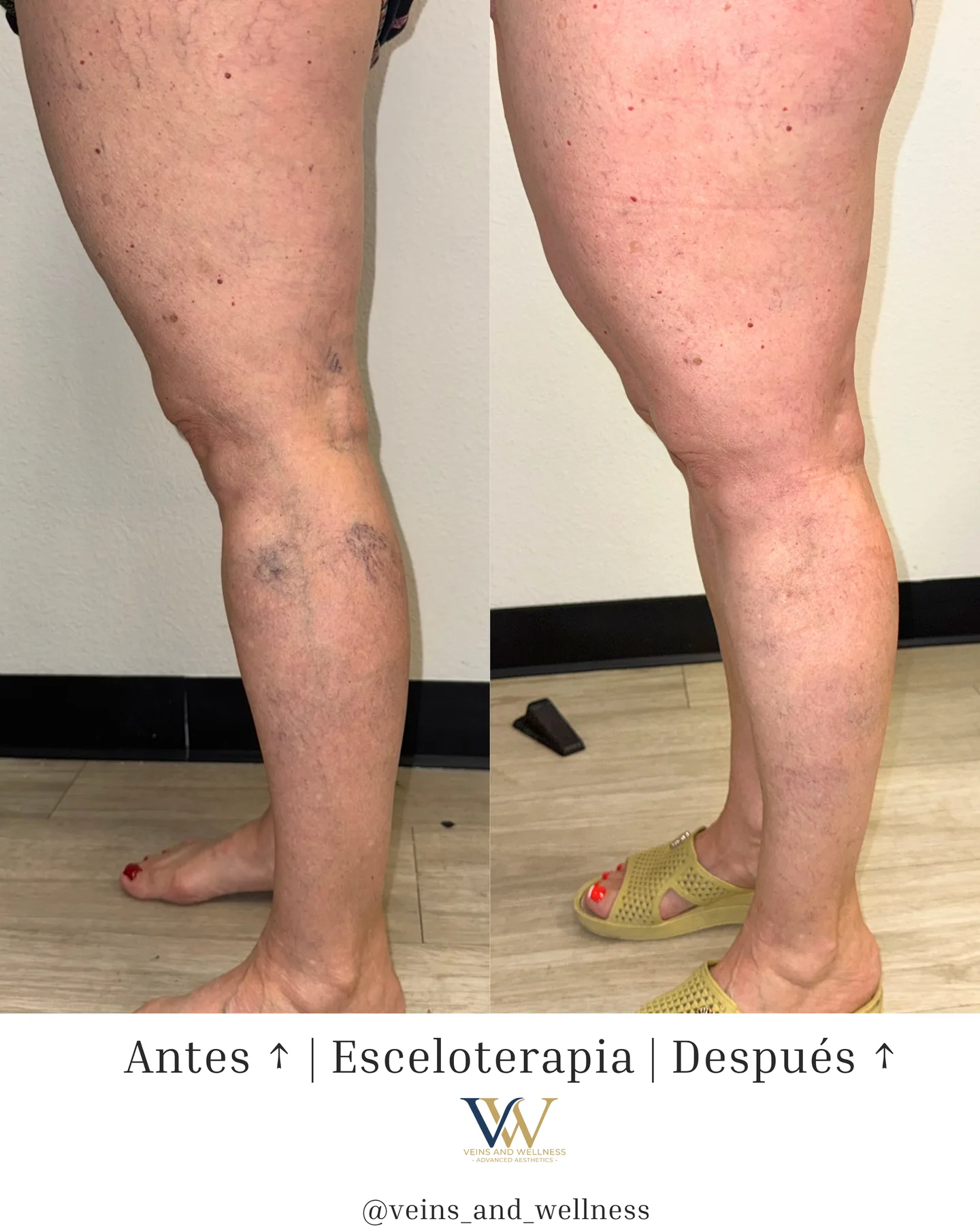 Sclerotherapy — before and after, calf