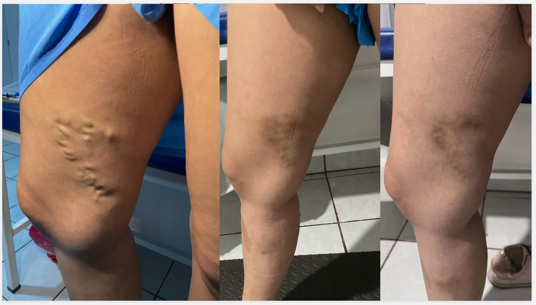 Varicose veins — before, during and after treatment