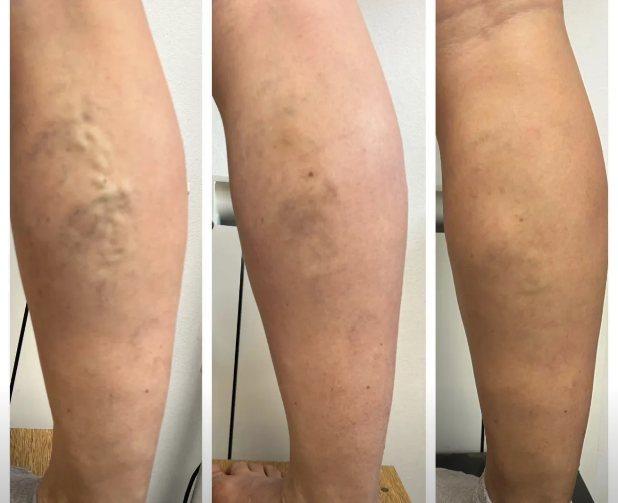 Varicose veins — treatment progression
