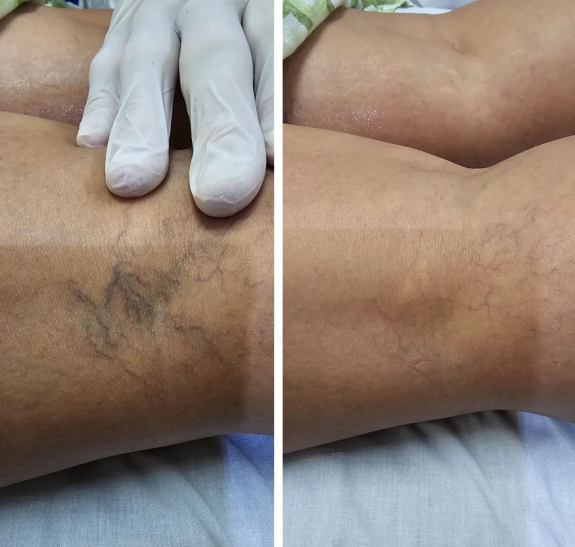 Spider veins — before and after sclerotherapy