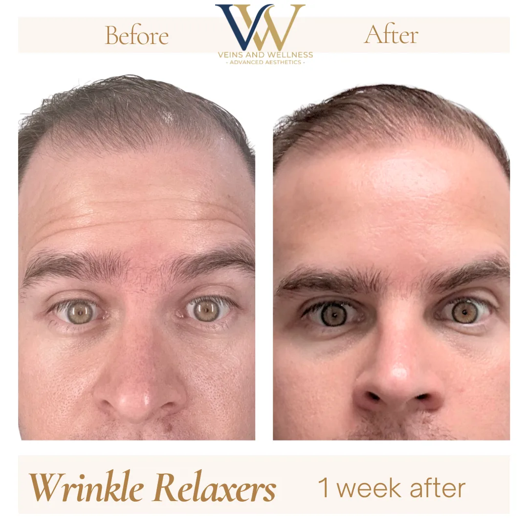 Wrinkle Relaxers before and after at Veins and Wellness Las Vegas