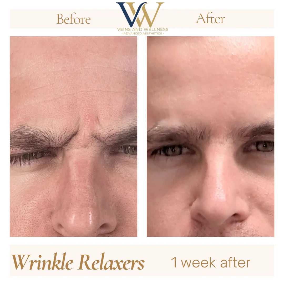 Wrinkle Relaxers before and after at Veins and Wellness Las Vegas