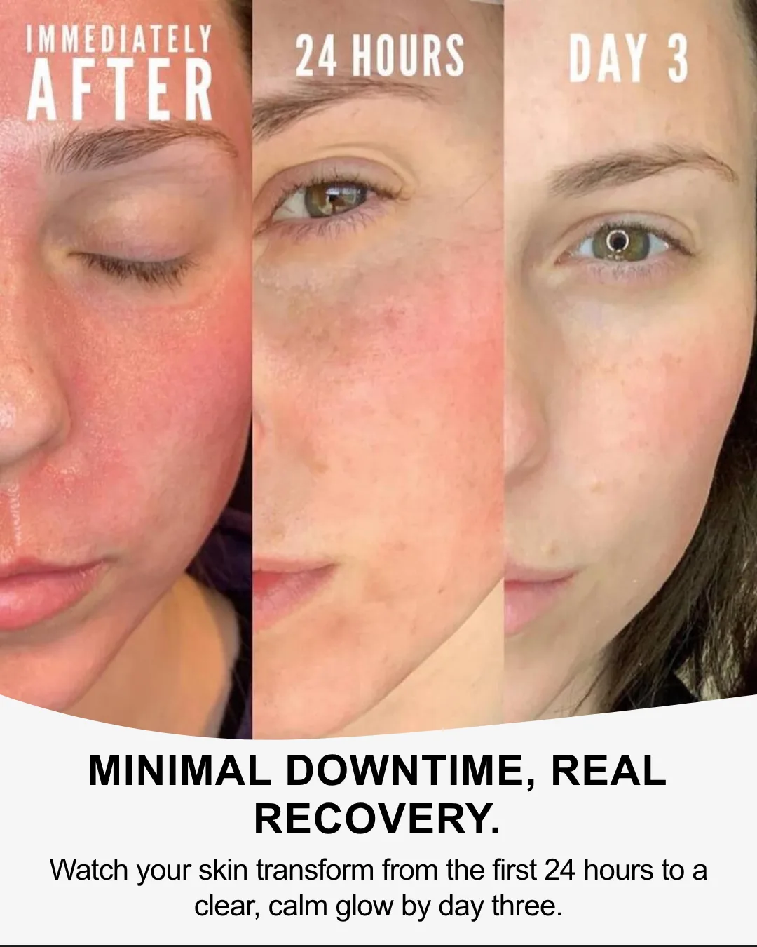 CoolPeel recovery — immediately after, 24 hours, day 3