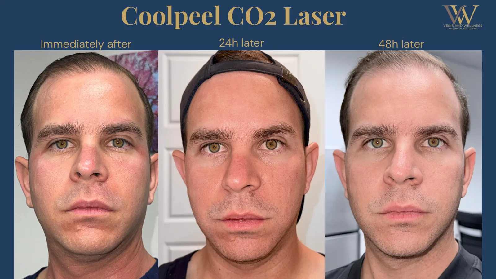 CoolPeel CO2 recovery: immediately after, 24 hours later and 48 hours later