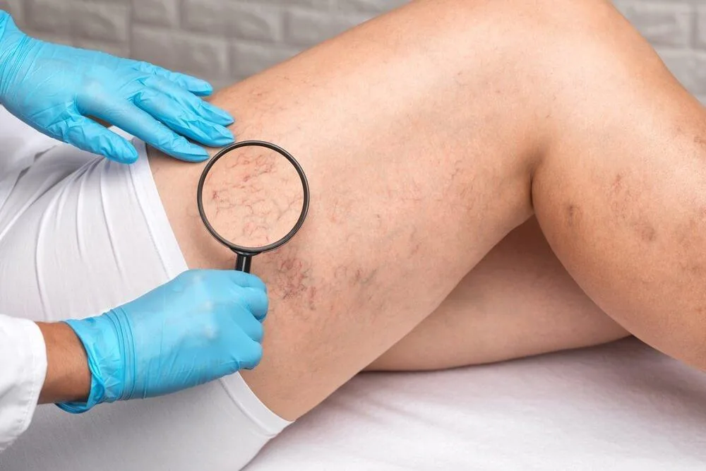 Sclerotherapy
