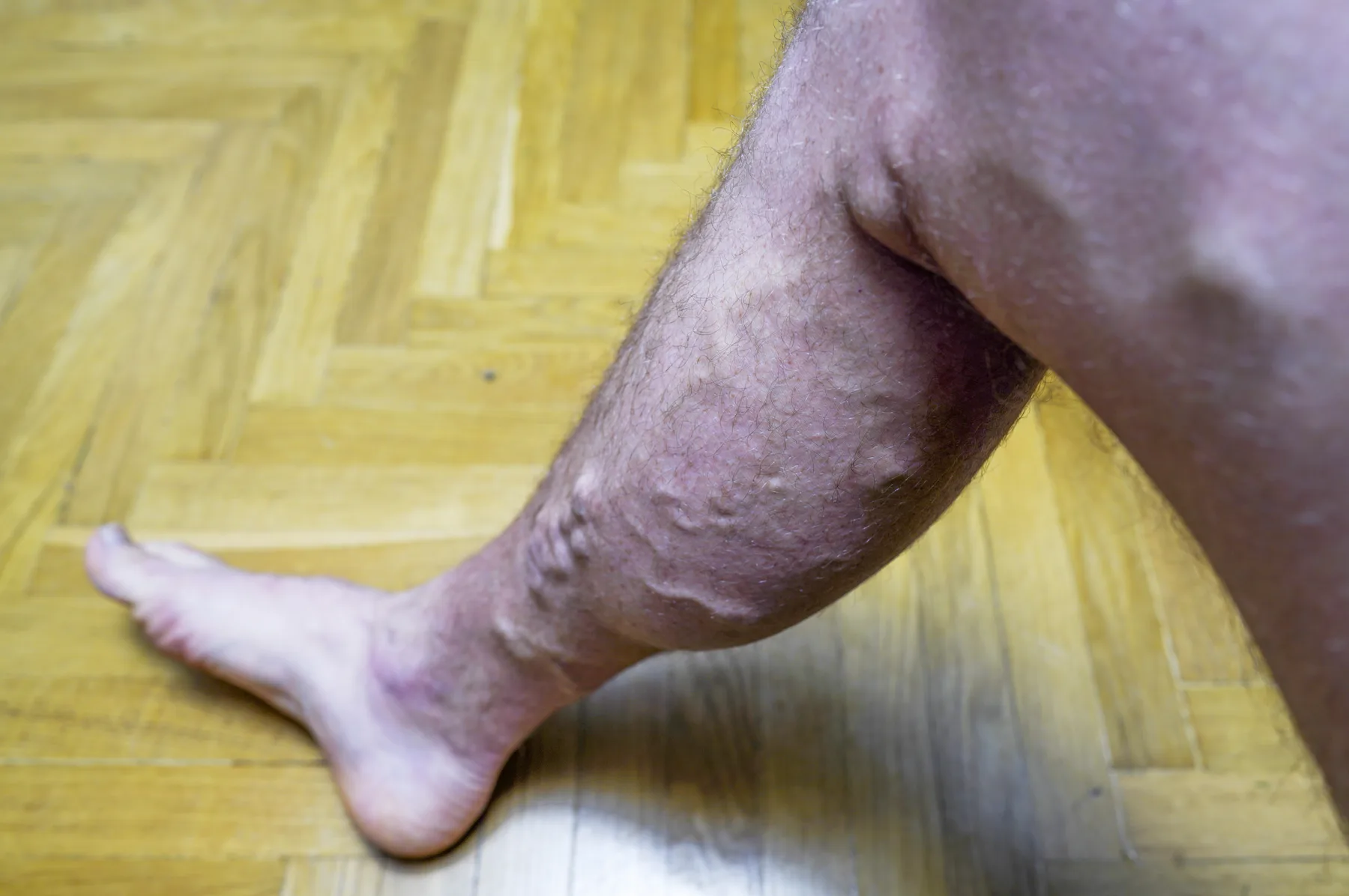 Varicose veins — a treatable medical condition