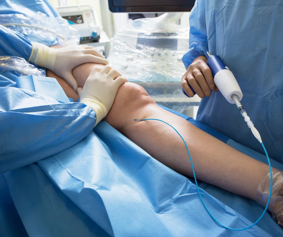 Ultrasound-guided vein ablation / Varithena catheter procedure